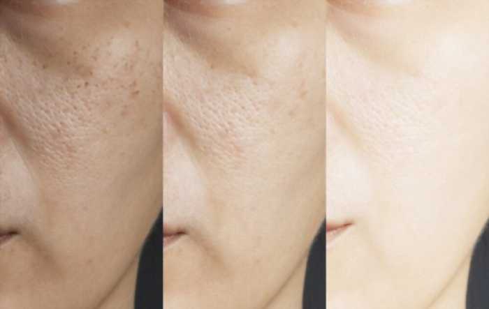 essential oils to tighten enlarged pores